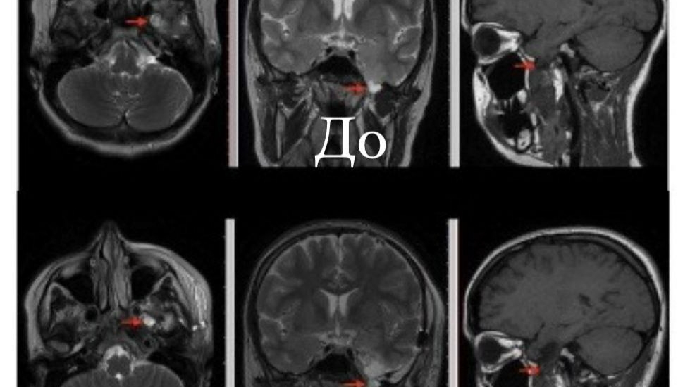 Петербургские нейрохирурги спасли жизнь 17-летней пациентке с редкой формой анамалии мозга
